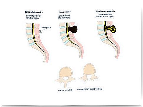 spina bifida