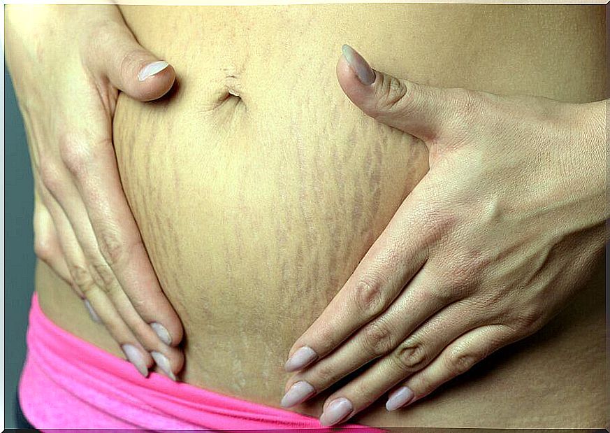 How to eliminate stretch marks during pregnancy?