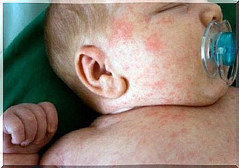 What You Didn't Know About Scarlet fever